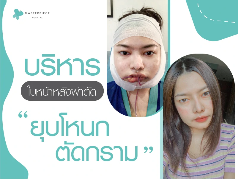การบริหารใบหน้าหลังผ่าตัดลดโหนกแก้ม…